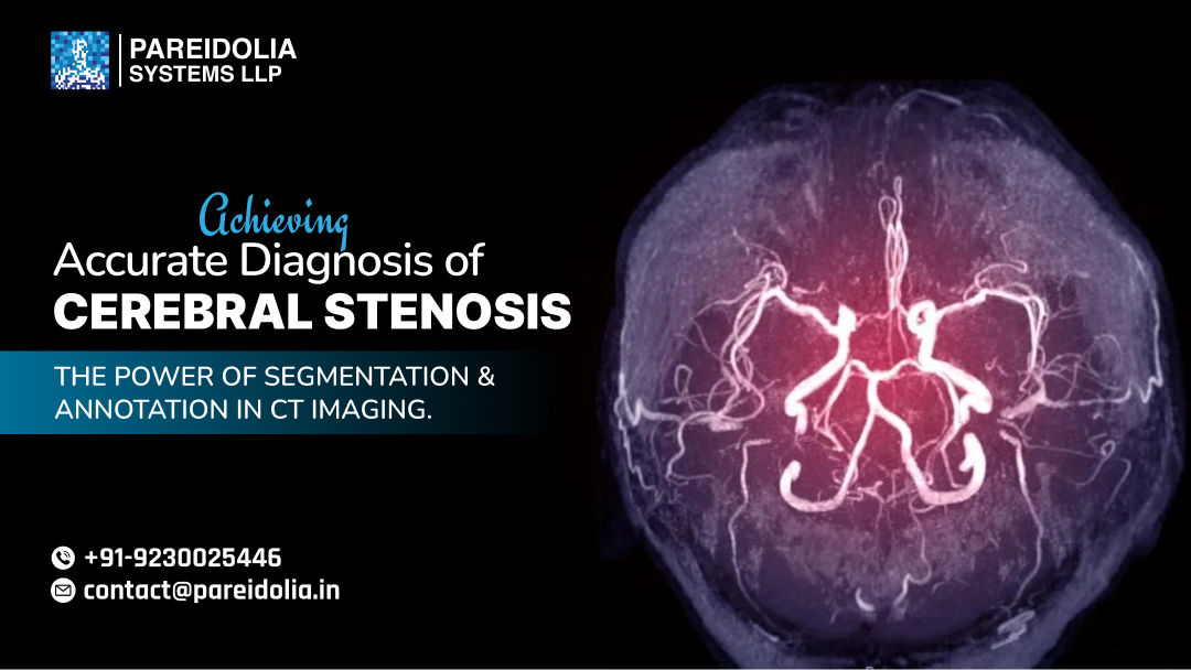 Cerebral Stenosis