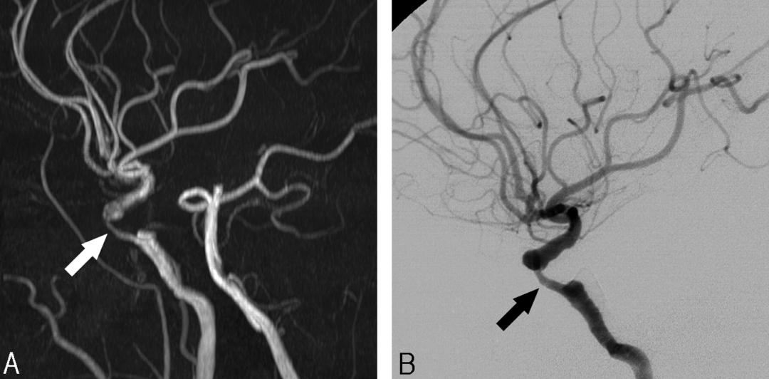 Cerebral Stenosis