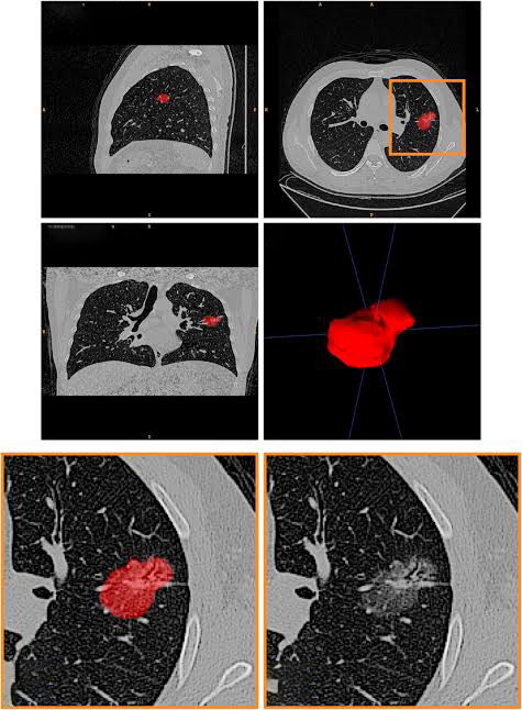 Artificial intelligence in lung cancer