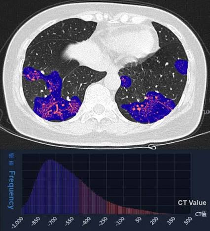 Artificial intelligence in lung cancer