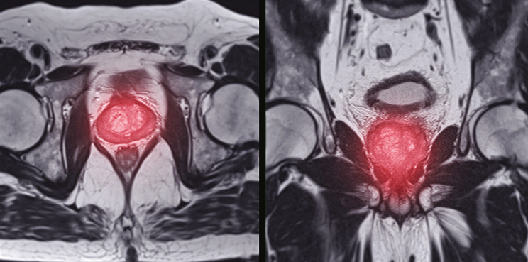 AI in Prostate Cancer